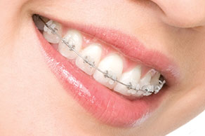 Clarity Esthetic Braces