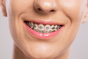 Traditional Braces